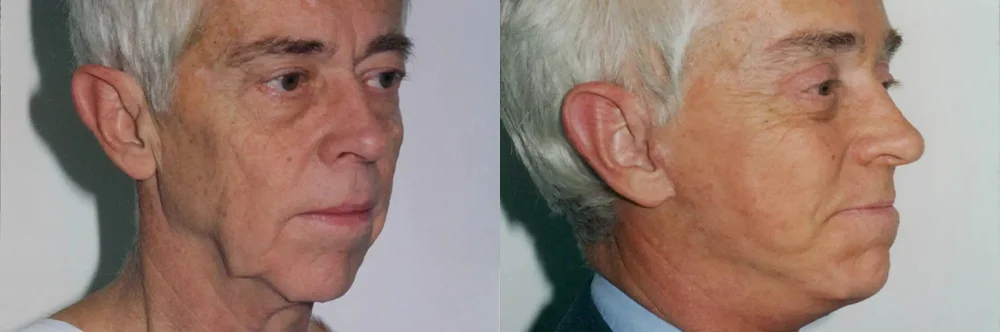 Real patient results in Newport Beach, CA Performed by Boris M. Ackerman MD