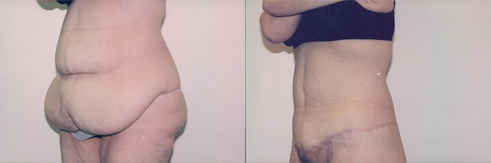 Real patient results in Newport Beach, CA Performed by Boris M. Ackerman MD
