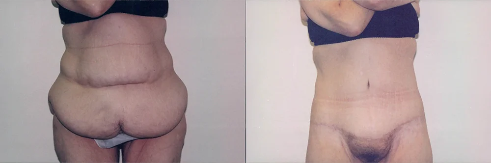 Real patient results in Newport Beach, CA Performed by Boris M. Ackerman MD
