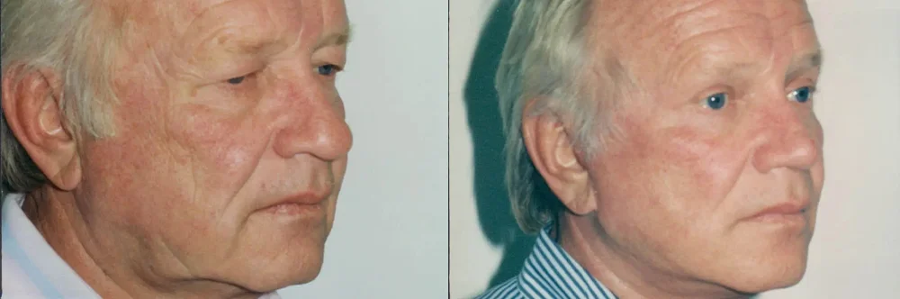 Real patient results in Newport Beach, CA Performed by Boris M. Ackerman MD