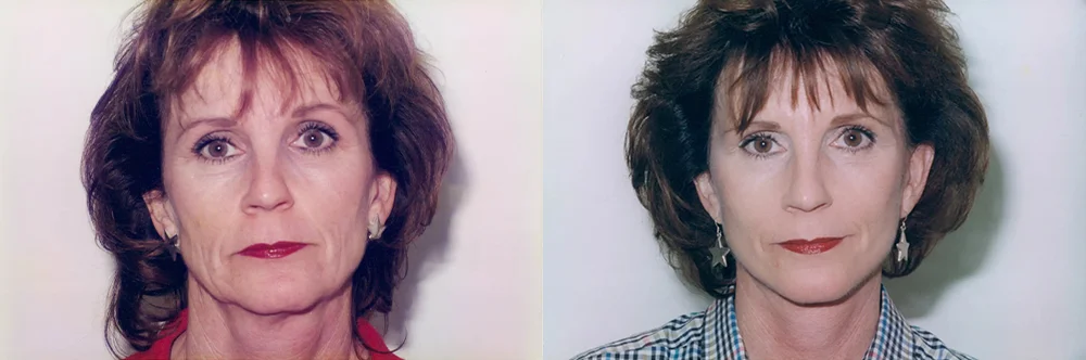 Real patient results in Newport Beach, CA Performed by Boris M. Ackerman MD