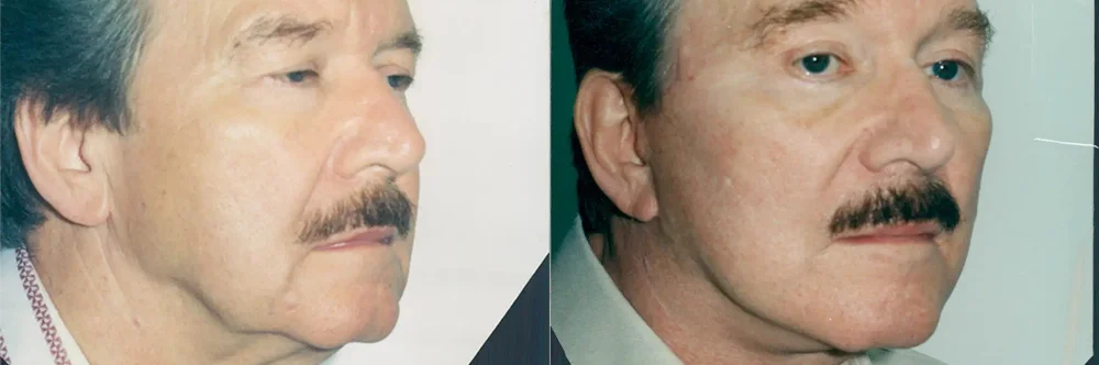 Real patient results in Newport Beach, CA Performed by Boris M. Ackerman MD
