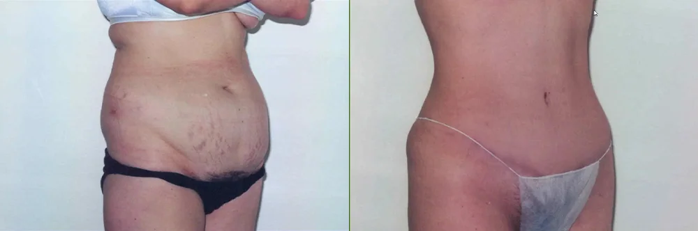 Real patient results in Newport Beach, CA Performed by Boris M. Ackerman MD