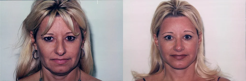 Real patient results in Newport Beach, CA Performed by Boris M. Ackerman MD