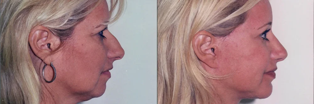 Real patient results in Newport Beach, CA Performed by Boris M. Ackerman MD