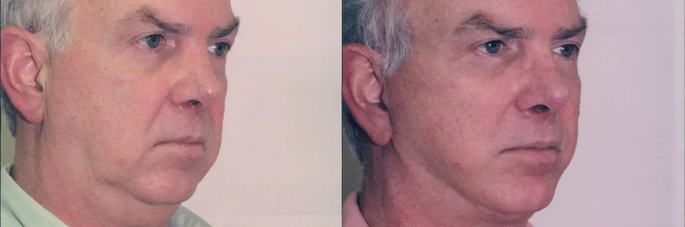 Real patient results in Newport Beach, CA Performed by Boris M. Ackerman MD