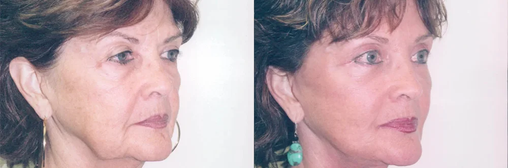 Real patient results in Newport Beach, CA Performed by Boris M. Ackerman MD