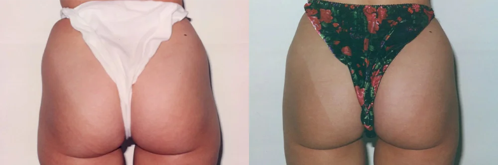 Real patient results in Newport Beach, CA Performed by Boris M. Ackerman MD