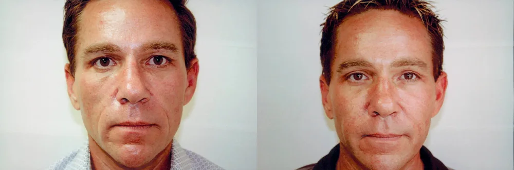 Real patient results in Newport Beach, CA Performed by Boris M. Ackerman MD
