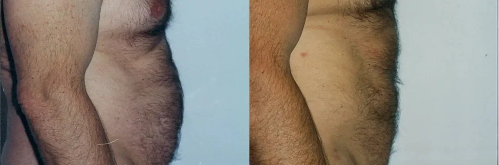 Real patient results in Newport Beach, CA Performed by Boris M. Ackerman MD