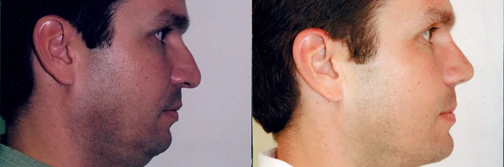 Real patient results in Newport Beach, CA Performed by Boris M. Ackerman MD