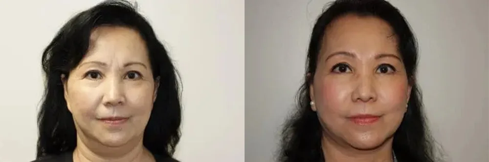 Real patient results in Newport Beach, CA Performed by Boris M. Ackerman MD