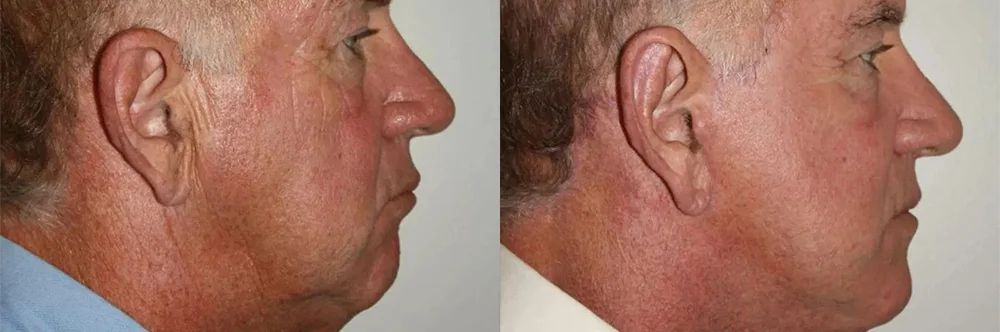 Real patient results in Newport Beach, CA Performed by Boris M. Ackerman MD