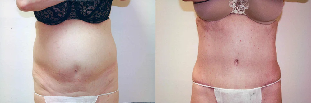 Real patient results in Newport Beach, CA Performed by Boris M. Ackerman MD