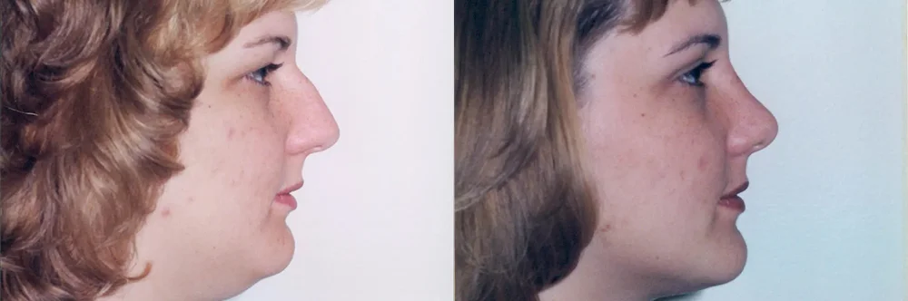 Real patient results in Newport Beach, CA Performed by Boris M. Ackerman MD