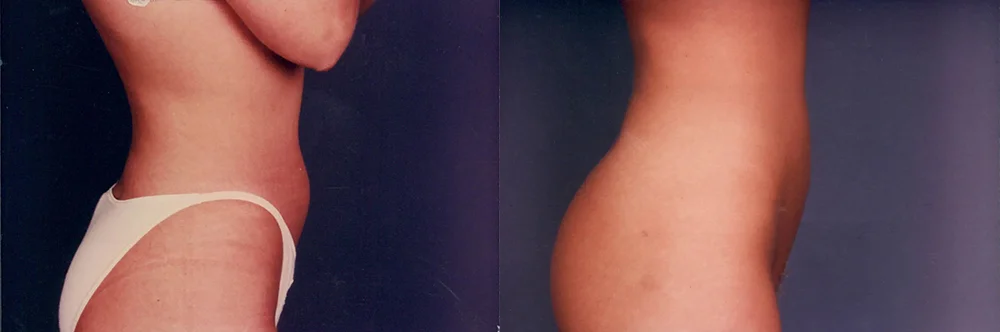 Real patient results in Newport Beach, CA Performed by Boris M. Ackerman MD