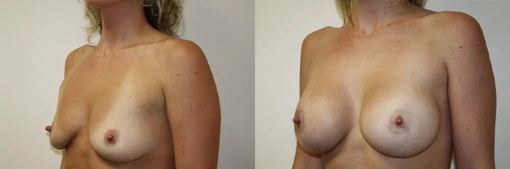 Real patient results in Newport Beach, CA Performed by Boris M. Ackerman MD