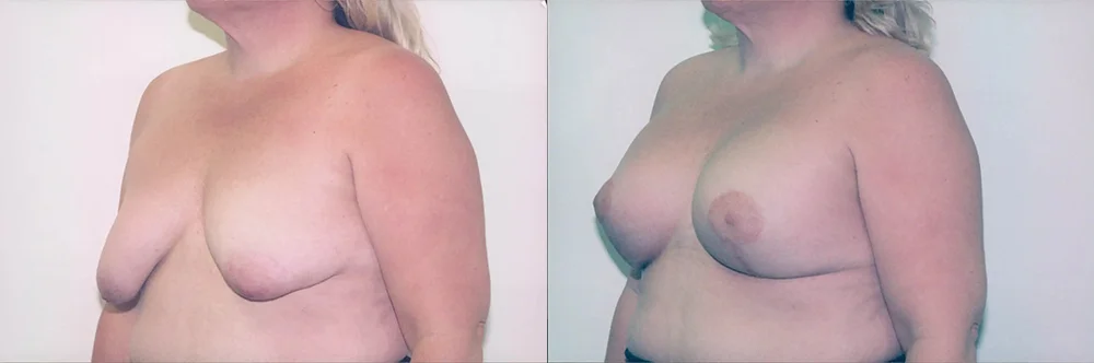 Real patient results in Newport Beach, CA Performed by Boris M. Ackerman MD