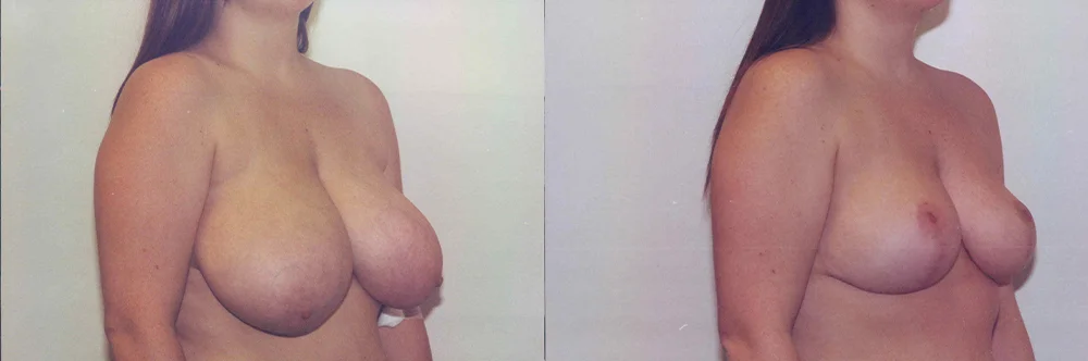 Real patient results in Newport Beach, CA Performed by Boris M. Ackerman MD