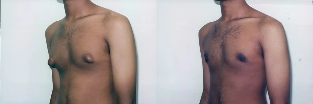 Real patient results in Newport Beach, CA Performed by Boris M. Ackerman MD