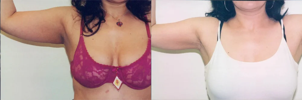 Real patient results in Newport Beach, CA Performed by Boris M. Ackerman MD