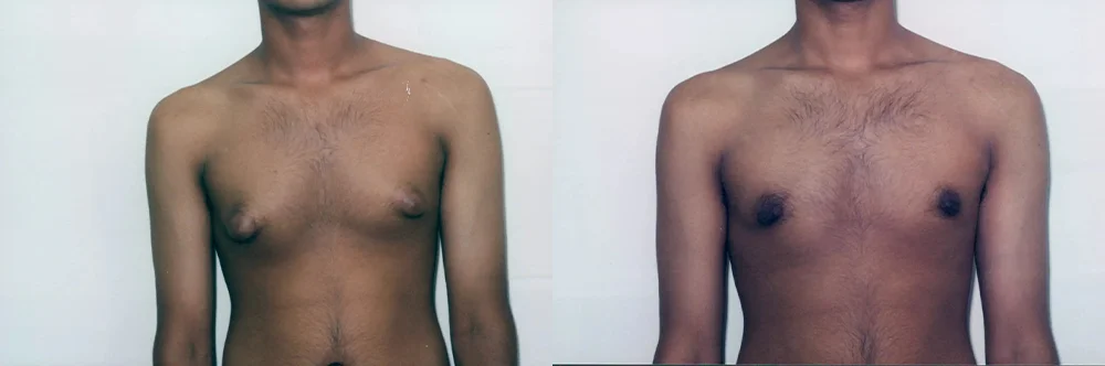 Real patient results in Newport Beach, CA Performed by Boris M. Ackerman MD