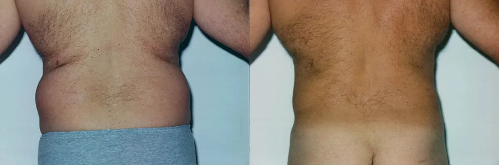 Real patient results in Newport Beach, CA Performed by Boris M. Ackerman MD