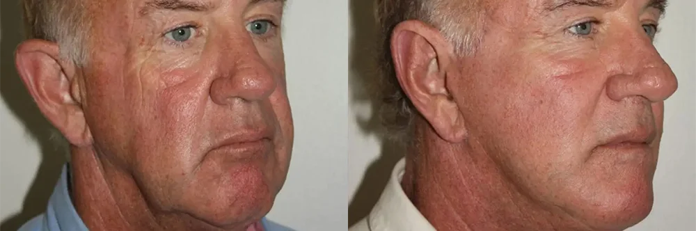 Real patient results in Newport Beach, CA Performed by Boris M. Ackerman MD