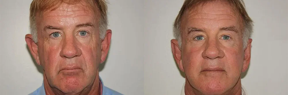 Real patient results in Newport Beach, CA Performed by Boris M. Ackerman MD