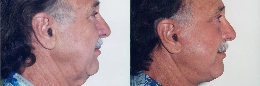 Real patient results in Newport Beach, CA Performed by Boris M. Ackerman MD