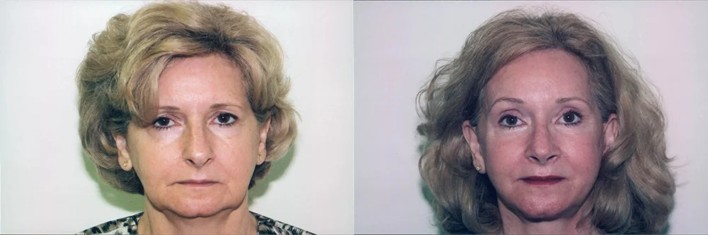 Real patient results in Newport Beach, CA Performed by Boris M. Ackerman MD