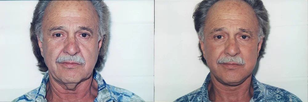 Real patient results in Newport Beach, CA Performed by Boris M. Ackerman MD