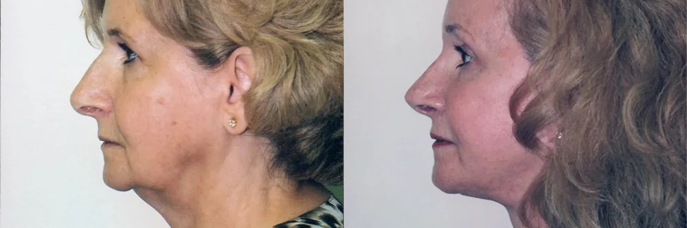 Real patient results in Newport Beach, CA Performed by Boris M. Ackerman MD