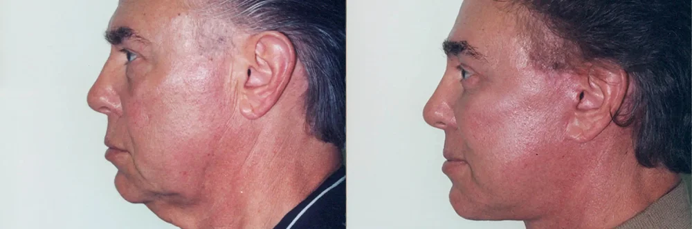 Real patient results in Newport Beach, CA Performed by Boris M. Ackerman MD