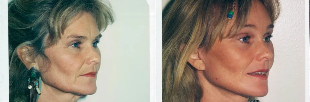 Real patient results in Newport Beach, CA Performed by Boris M. Ackerman MD