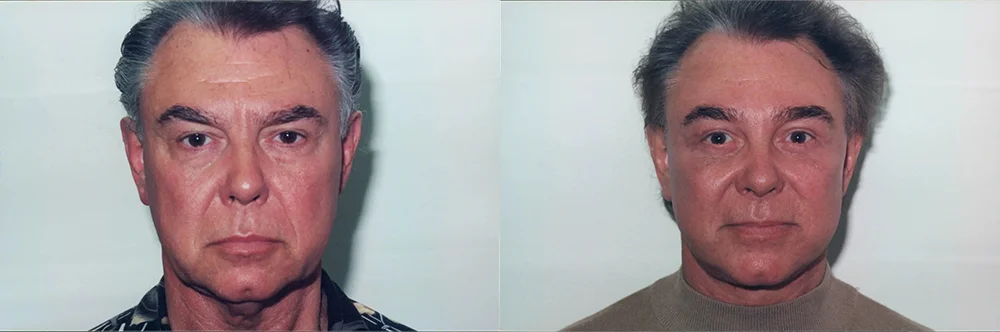 Real patient results in Newport Beach, CA Performed by Boris M. Ackerman MD