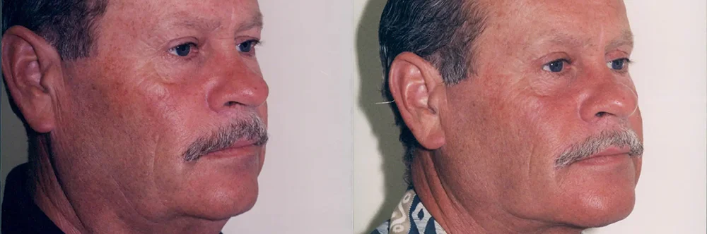Real patient results in Newport Beach, CA Performed by Boris M. Ackerman MD
