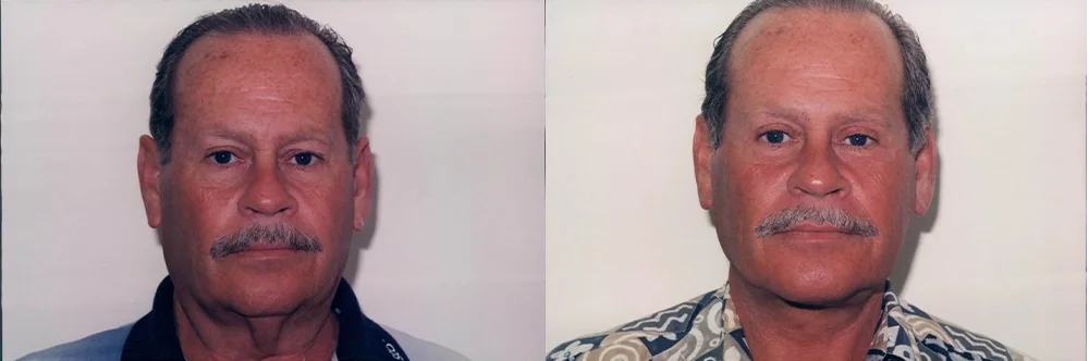 Real patient results in Newport Beach, CA Performed by Boris M. Ackerman MD