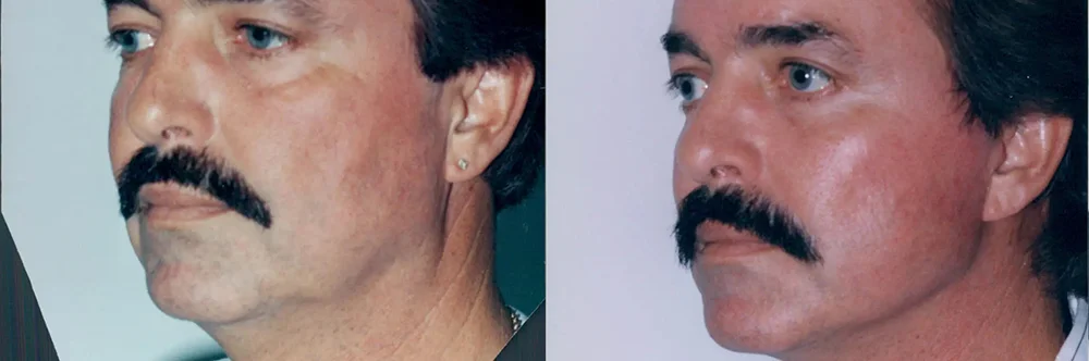 Real patient results in Newport Beach, CA Performed by Boris M. Ackerman MD