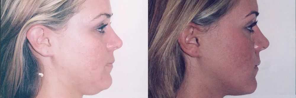 Real patient results in Newport Beach, CA Performed by Boris M. Ackerman MD