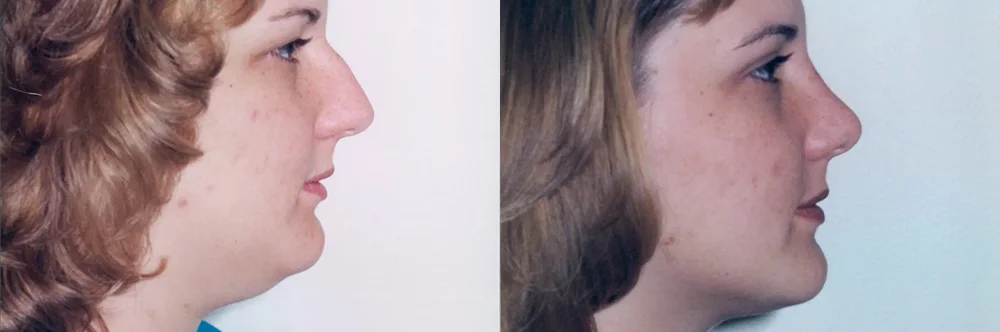 Real patient results in Newport Beach, CA Performed by Boris M. Ackerman MD