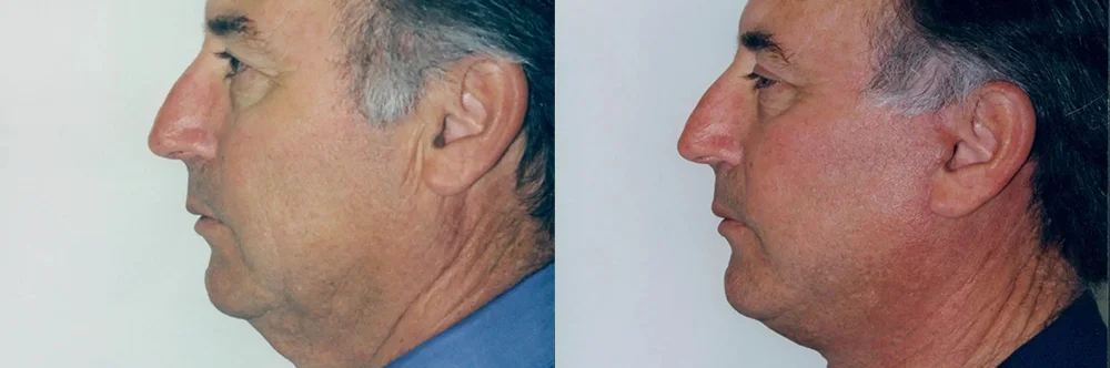 Real patient results in Newport Beach, CA Performed by Boris M. Ackerman MD