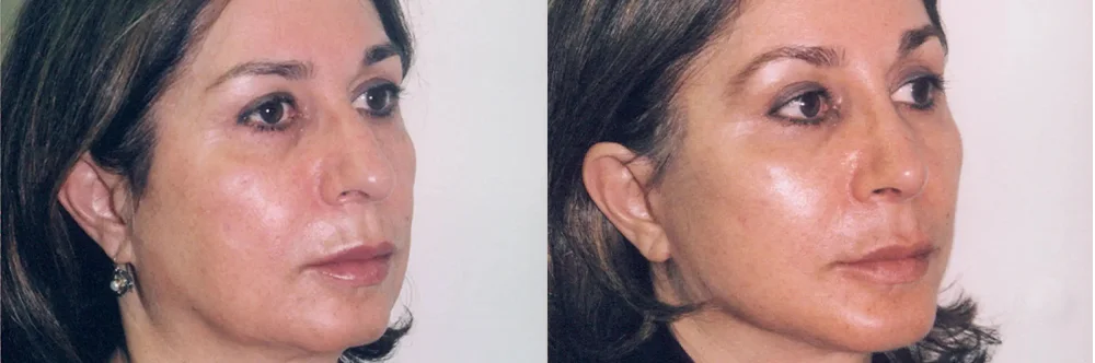 Real patient results in Newport Beach, CA Performed by Boris M. Ackerman MD