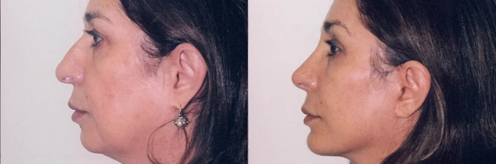 Real patient results in Newport Beach, CA Performed by Boris M. Ackerman MD