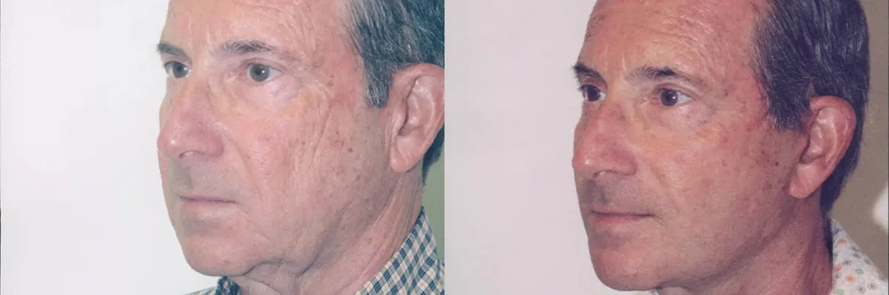 Real patient results in Newport Beach, CA Performed by Boris M. Ackerman MD