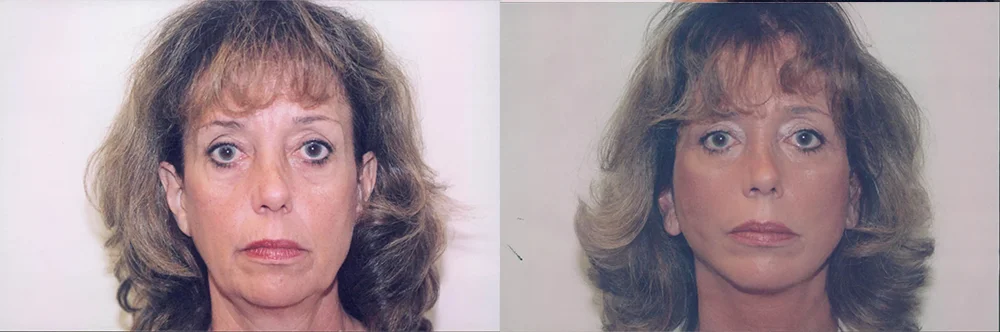 Real patient results in Newport Beach, CA Performed by Boris M. Ackerman MD