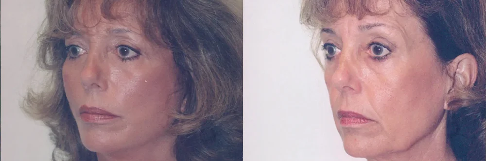 Real patient results in Newport Beach, CA Performed by Boris M. Ackerman MD