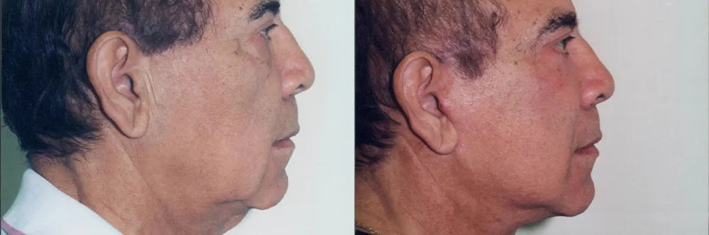 Real patient results in Newport Beach, CA Performed by Boris M. Ackerman MD