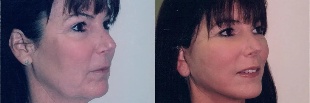 Real patient results in Newport Beach, CA Performed by Boris M. Ackerman MD