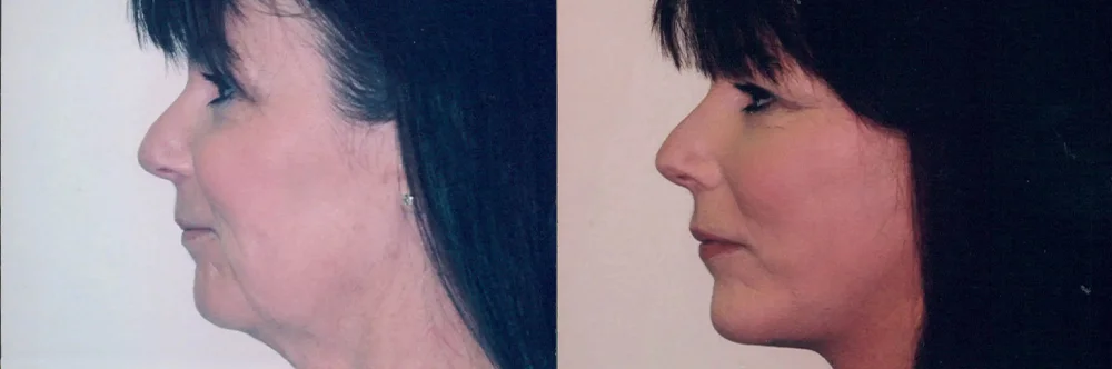 Real patient results in Newport Beach, CA Performed by Boris M. Ackerman MD